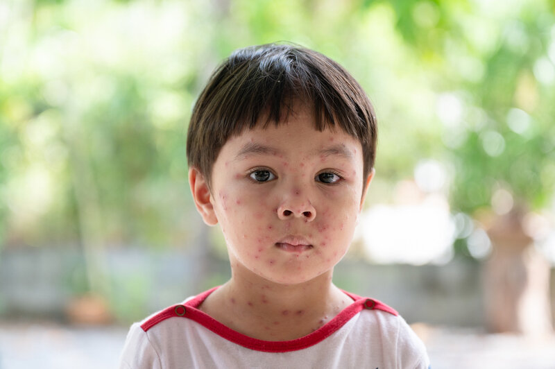child with chickenpox