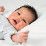 New,Born,Baby,With,Skin,Rashes,On,The,Cheeks,,Inflamed
