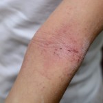 Dermatitis.