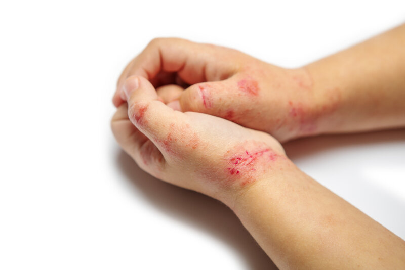 Understanding Eczema – Causes, Symptoms and Treatment