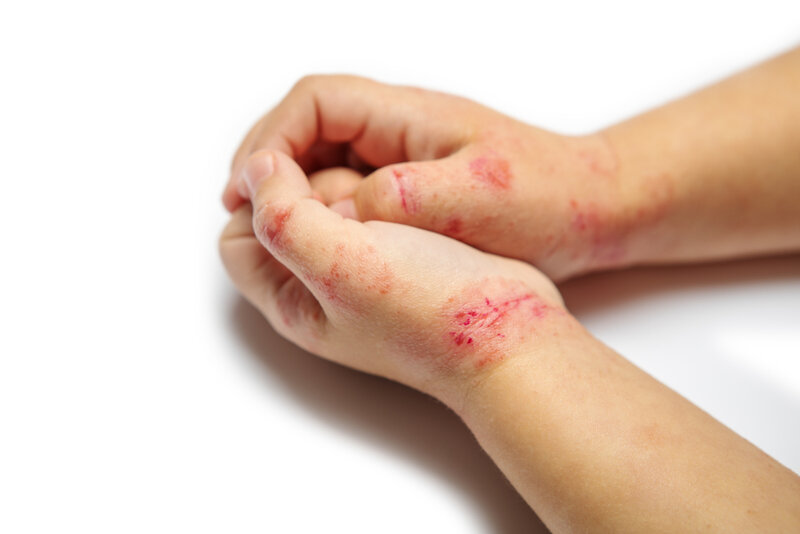 child with eczema on their hands