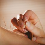 Young,Woman,Getting,Acupuncture,Treatment,In,Therapy,Room