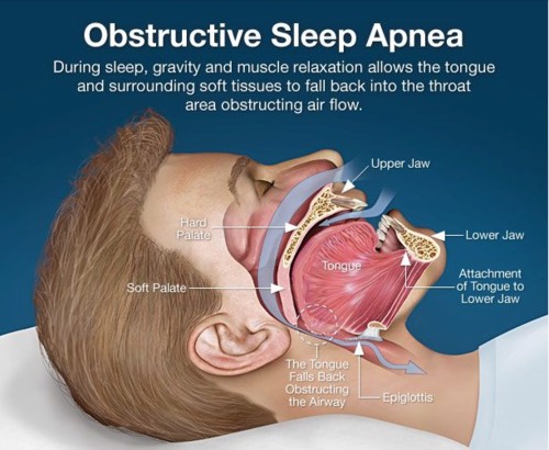 obstructive sleep apnoea (OSA) infographic