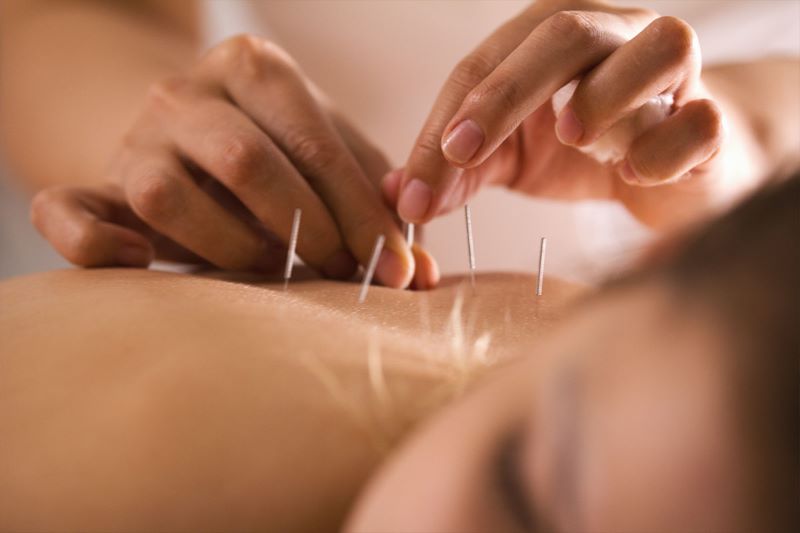 acupuncture for morning sickness