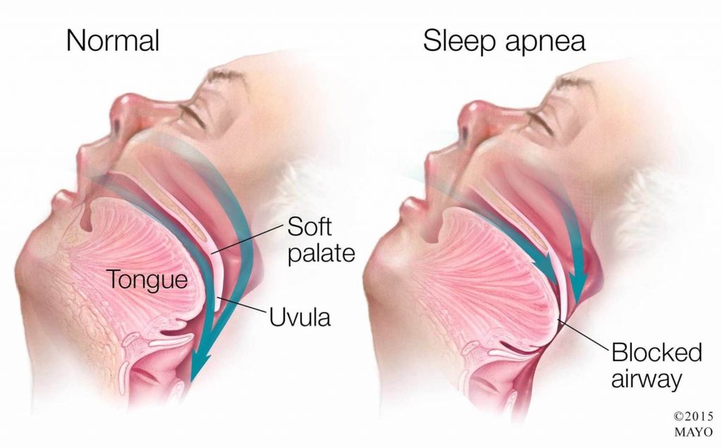 Normal person vs. someone with obstructive sleep apnea